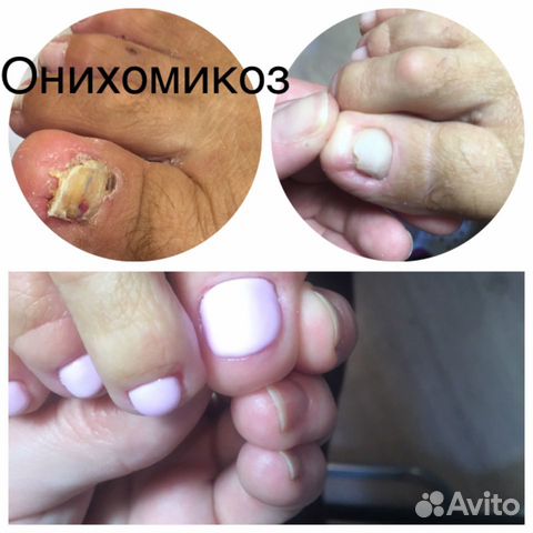 Медицинский педикюр,маникюр выезд на дом